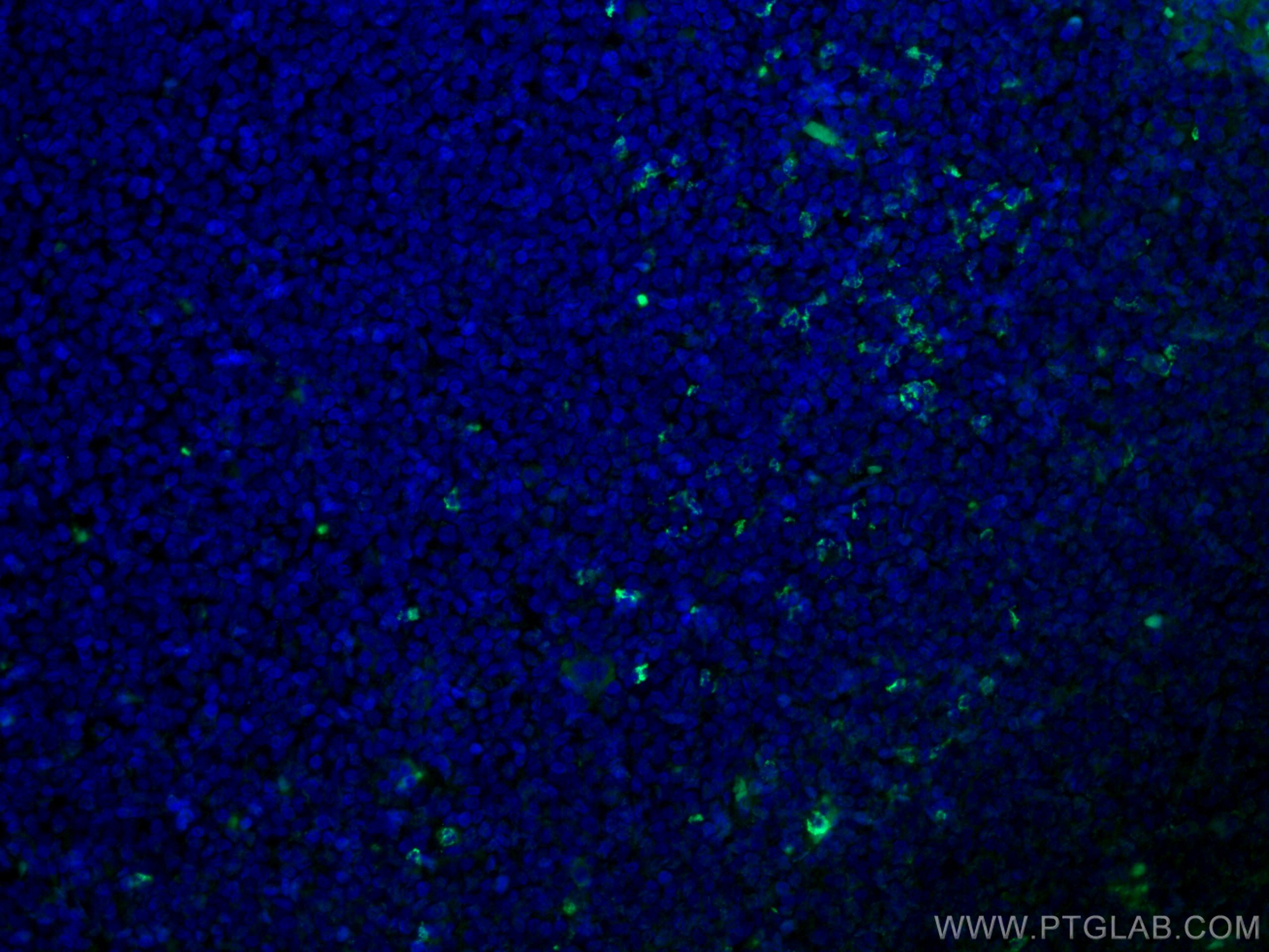 Alpha Antichymotrypsin