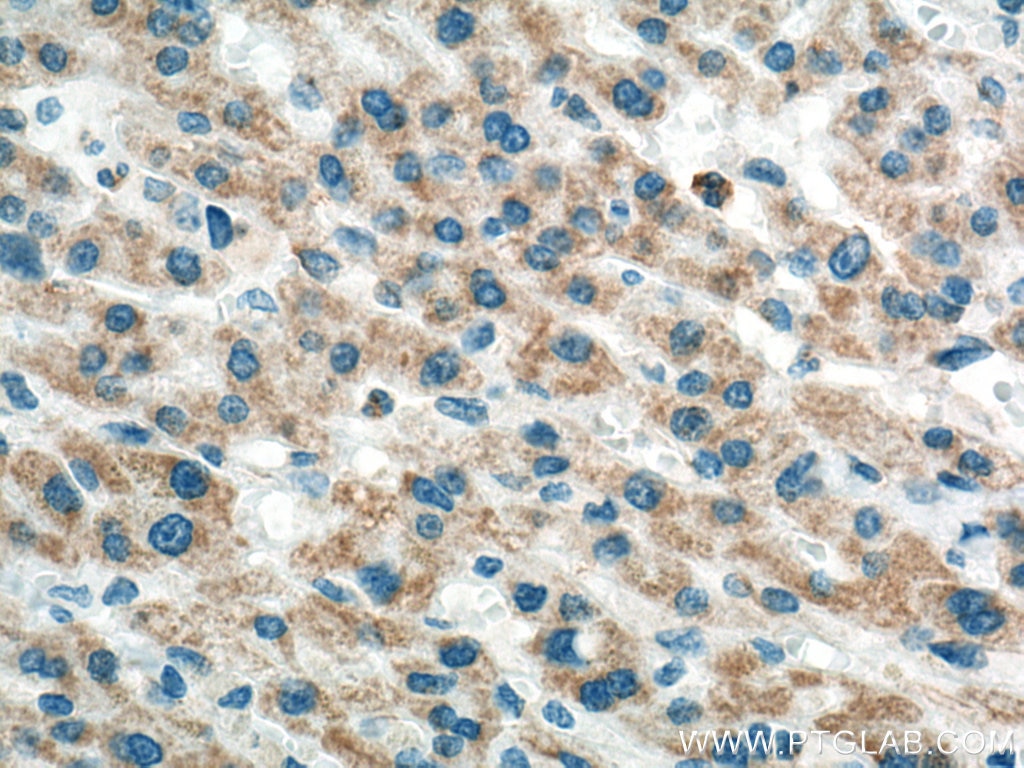 Immunohistochemistry (IHC) staining of human liver cancer tissue using Biotin-conjugated Alpha Tubulin Monoclonal antibod (Biotin-66031)