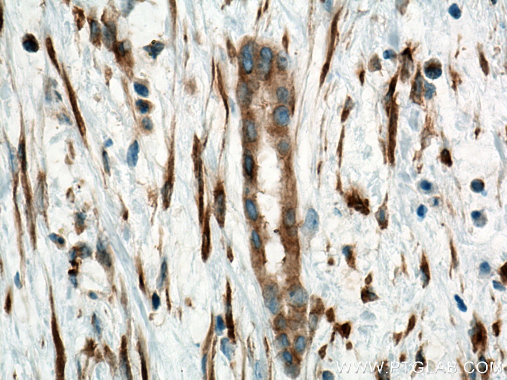 Immunohistochemistry (IHC) staining of human liver cancer tissue using Biotin-conjugated Alpha Tubulin Monoclonal antibod (Biotin-66031)