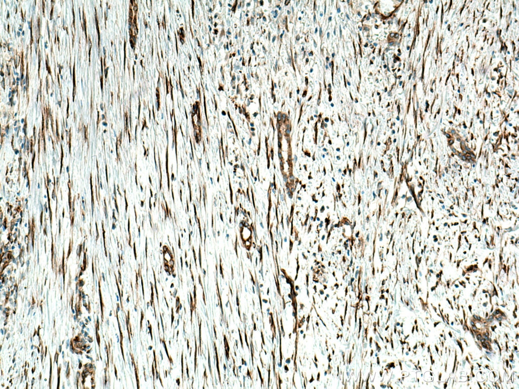 Immunohistochemistry (IHC) staining of human liver cancer tissue using Biotin-conjugated Alpha Tubulin Monoclonal antibod (Biotin-66031)