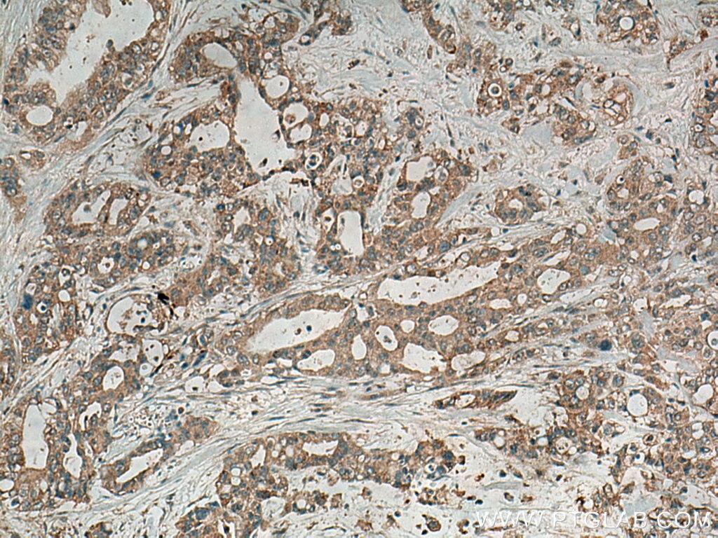 Immunohistochemistry (IHC) staining of human pancreas cancer tissue using Alpha Internexin Polyclonal antibody (23881-1-AP)
