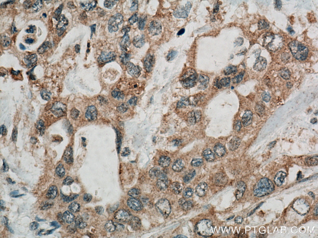 Immunohistochemistry (IHC) staining of human pancreas cancer tissue using Alpha Internexin Polyclonal antibody (23881-1-AP)