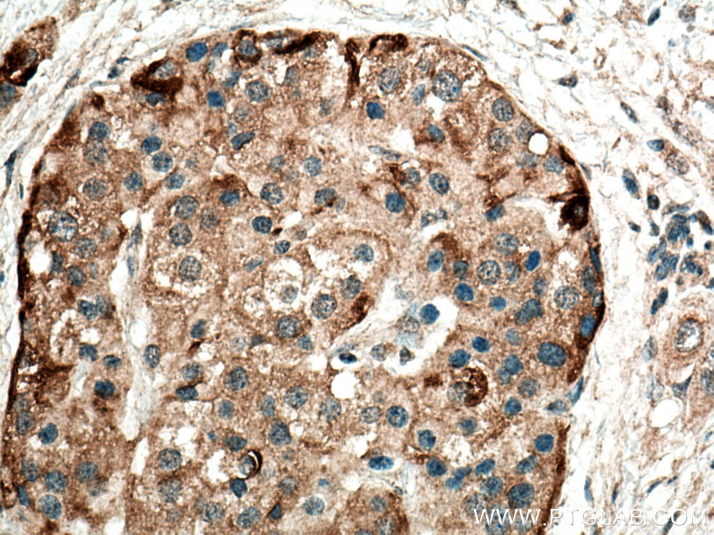 IHC staining of human pancreas cancer using 23881-1-AP
