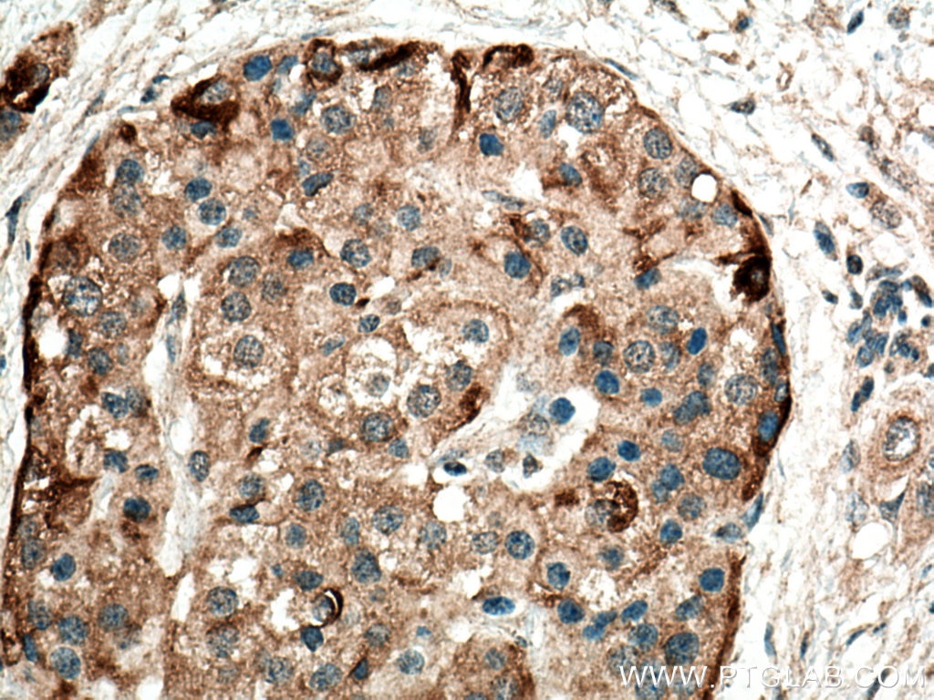 Immunohistochemistry (IHC) staining of human pancreas cancer tissue using Alpha Internexin Polyclonal antibody (23881-1-AP)