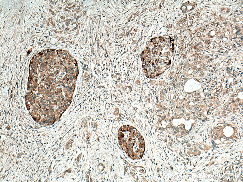 Immunohistochemistry (IHC) staining of human pancreas cancer tissue using Alpha Internexin Polyclonal antibody (23881-1-AP)