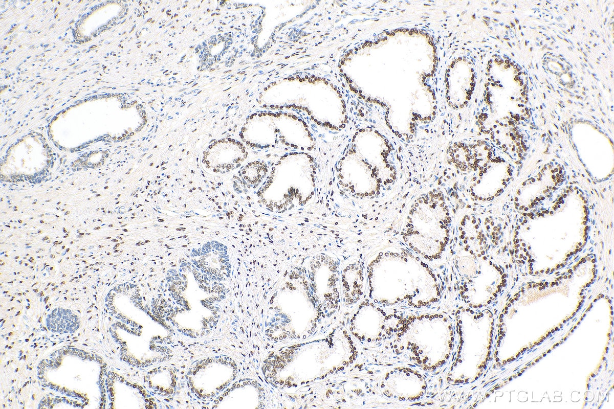 Immunohistochemistry (IHC) staining of human prostate cancer tissue using androgen receptor Recombinant antibody (81844-1-RR)
