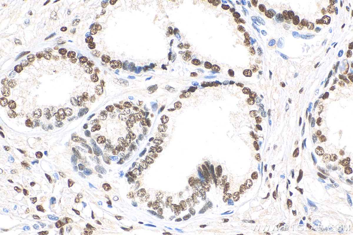 Immunohistochemistry (IHC) staining of human prostate cancer tissue using androgen receptor Recombinant antibody (81844-1-RR)