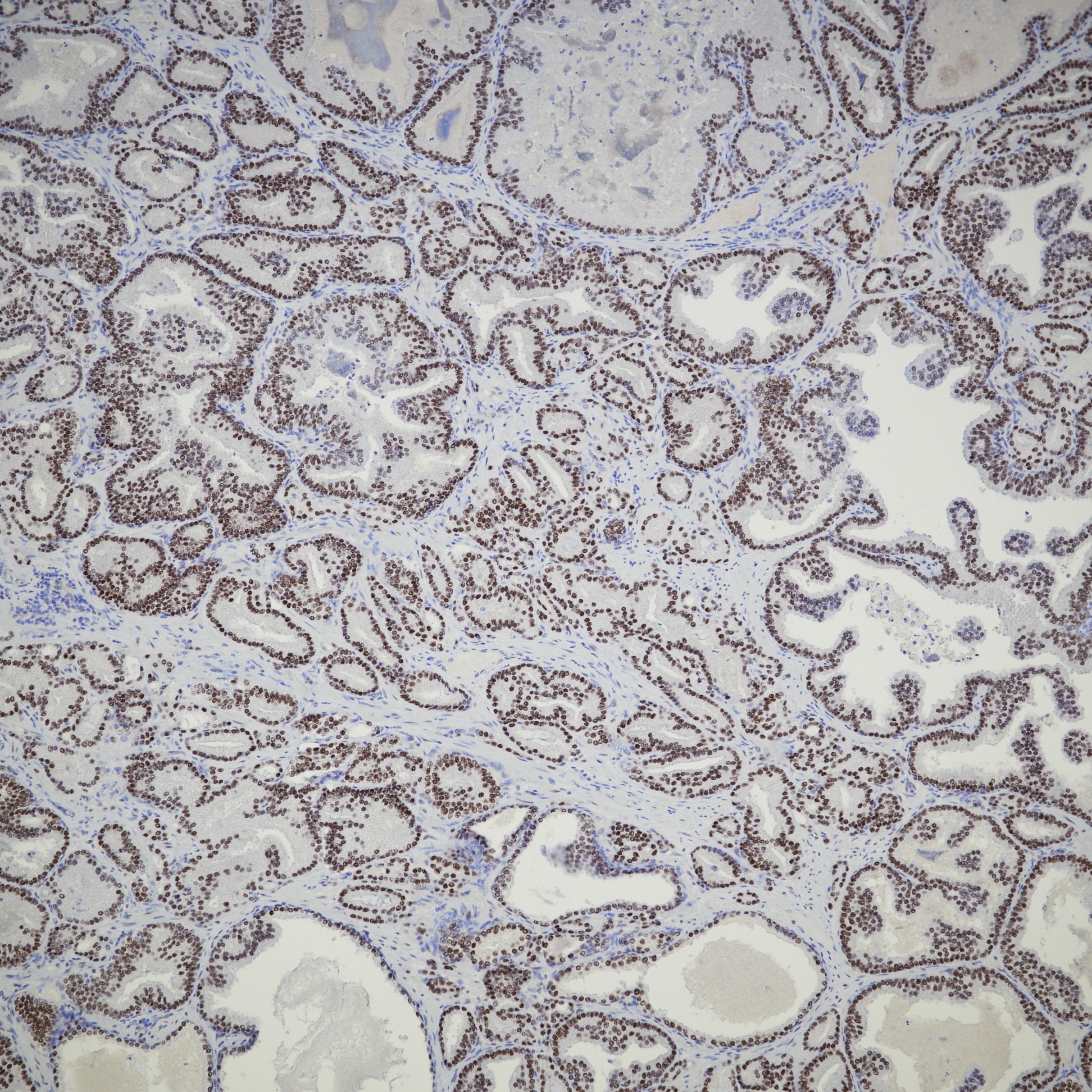 IHC staining of human prostate cancer using 81844-1-RR Immunohistochemistry (IHC) staining of human prostate cancer tissue using androgen receptor Recombinant monoclonal antibody (81844-1-RR)
