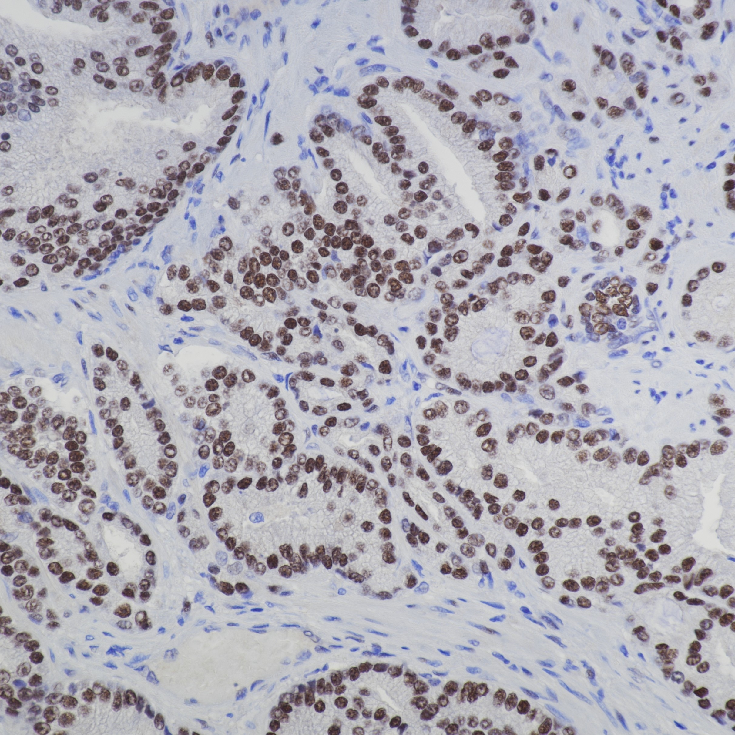 IHC staining of human prostate cancer using 81844-1-RR Immunohistochemistry (IHC) staining of human prostate cancer tissue using androgen receptor Recombinant monoclonal antibody (81844-1-RR)