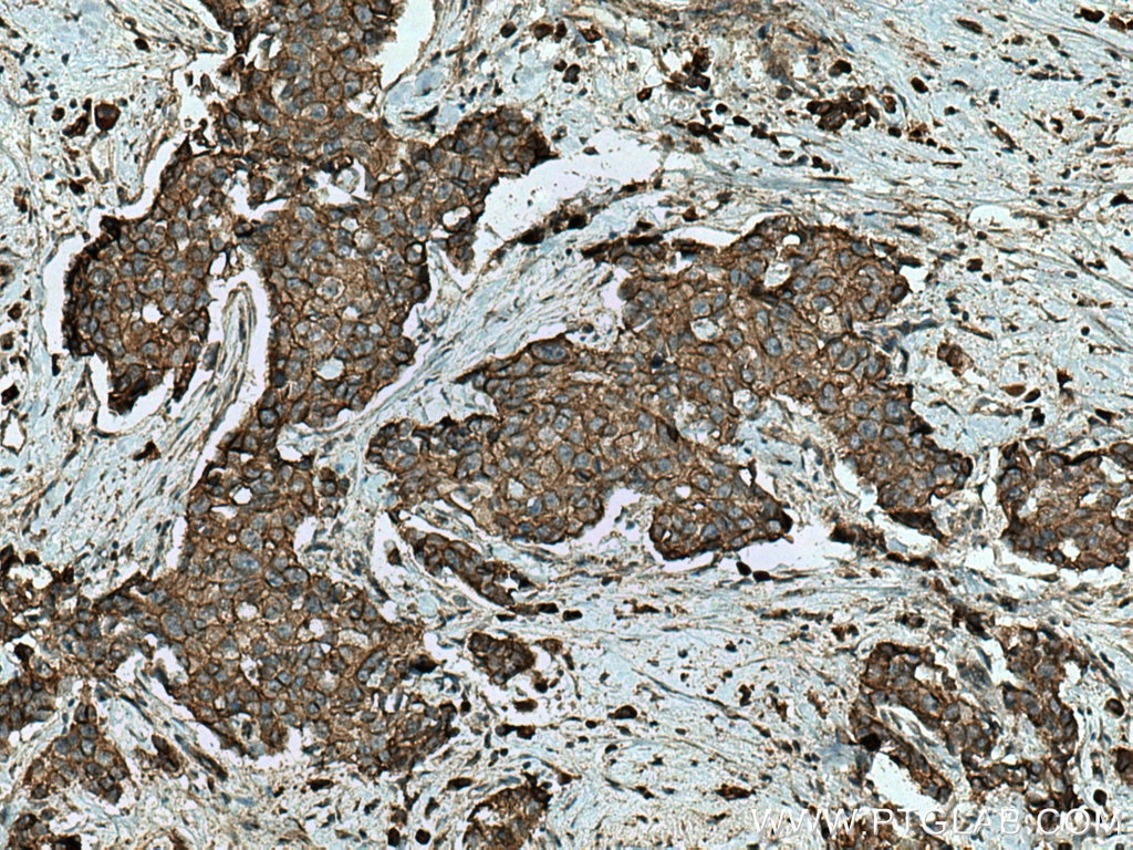 Immunohistochemistry (IHC) staining of human breast cancer tissue using Beta Catenin Polyclonal antibody (17565-1-AP)