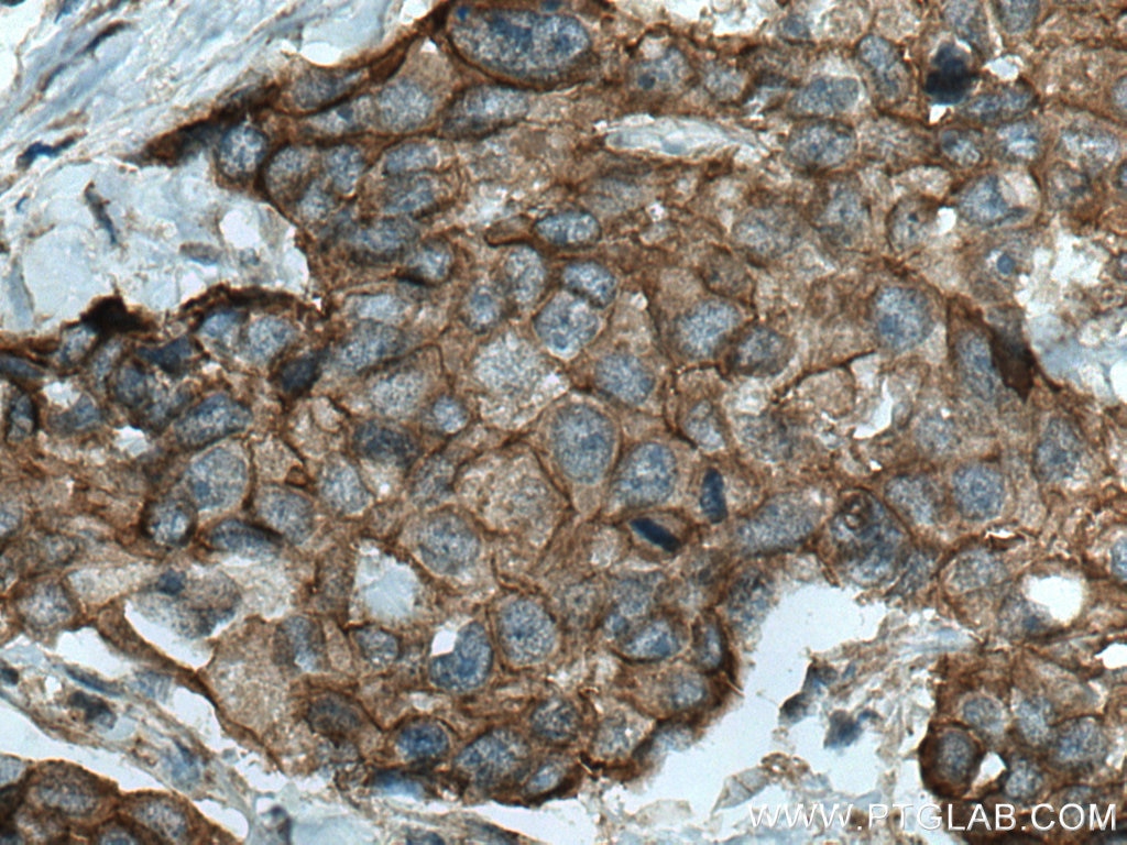 Immunohistochemistry (IHC) staining of human breast cancer tissue using Beta Catenin Polyclonal antibody (17565-1-AP)