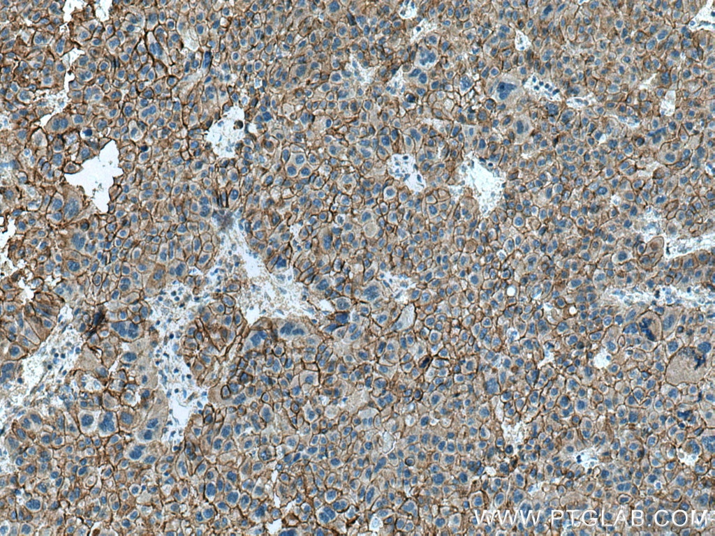 IHC staining of human liver cancer using 17565-1-AP