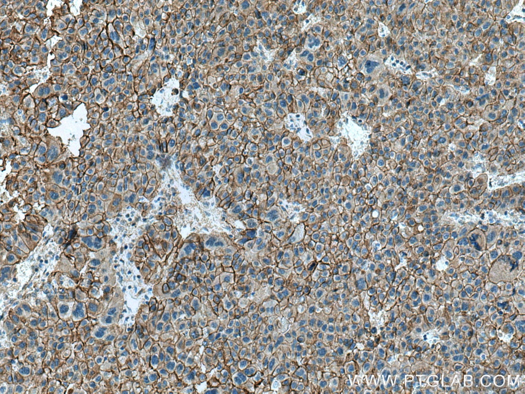 Immunohistochemistry (IHC) staining of human liver cancer tissue using Beta Catenin Polyclonal antibody (17565-1-AP)