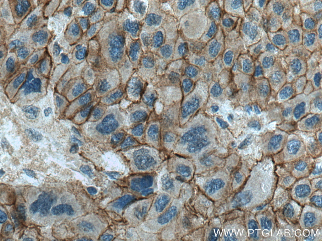 Immunohistochemistry (IHC) staining of human liver cancer tissue using Beta Catenin Polyclonal antibody (17565-1-AP)