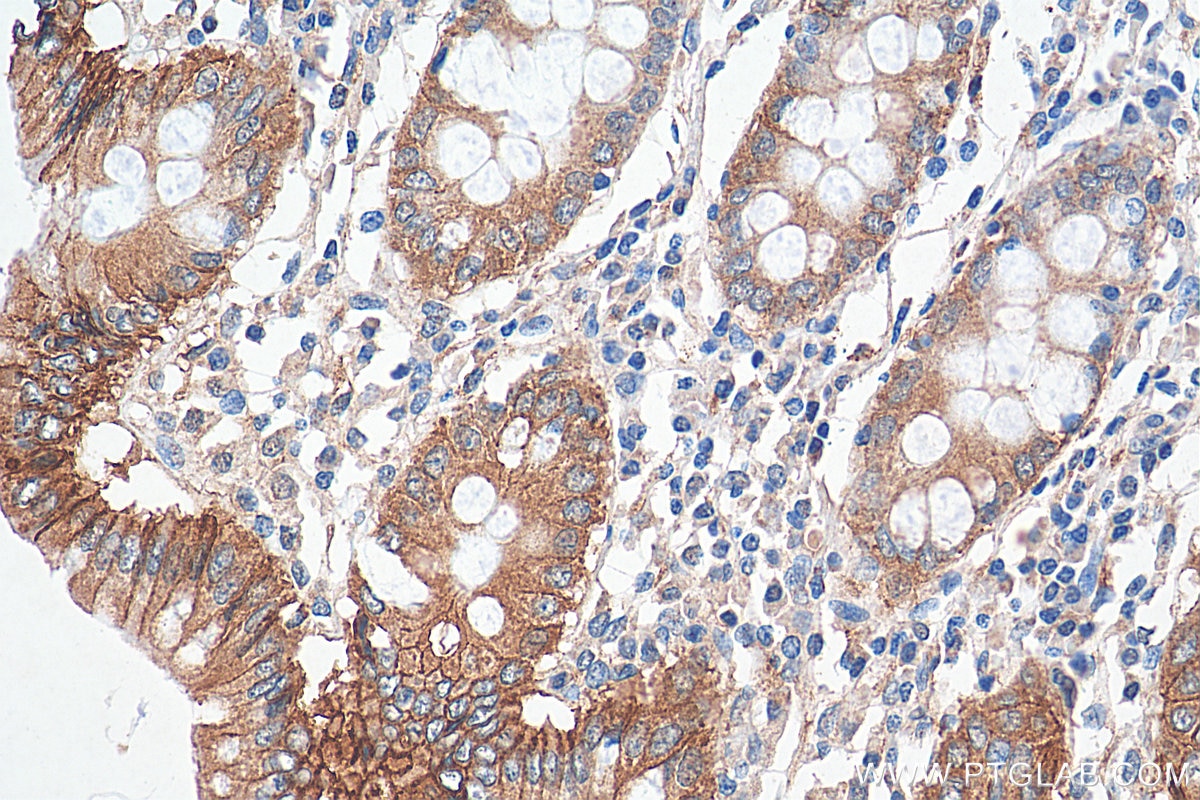 IHC staining of human colon using 17565-1-AP Immunohistochemistry (IHC) staining of human colon tissue using Beta Catenin Polyclonal antibody (17565-1-AP)