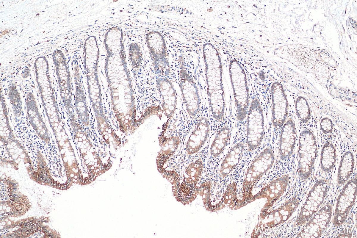 IHC staining of human colon using 17565-1-AP Immunohistochemistry (IHC) staining of human colon tissue using Beta Catenin Polyclonal antibody (17565-1-AP)