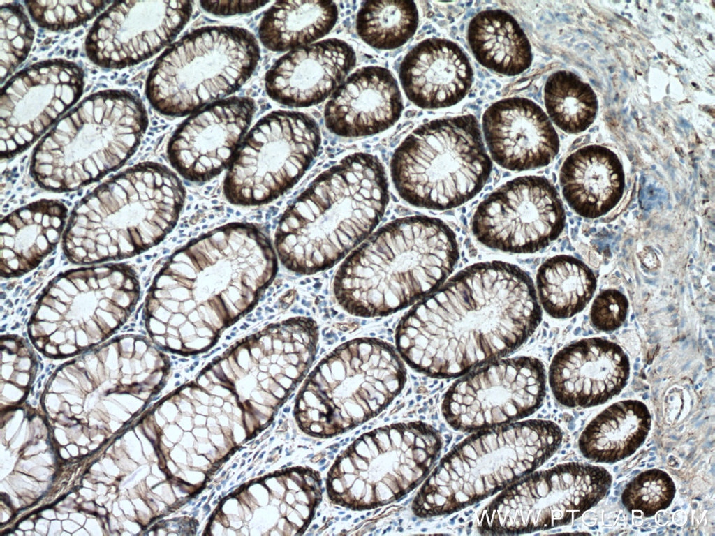 IHC staining of human colon cancer using 51067-2-AP