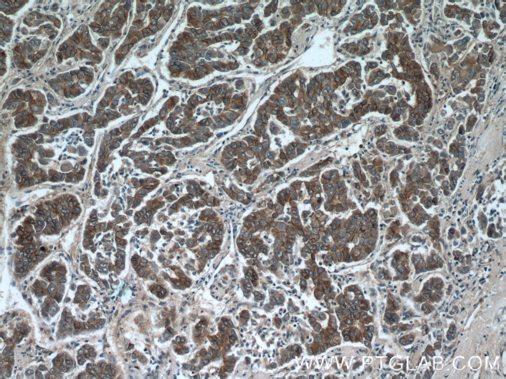 Immunohistochemistry (IHC) staining of human liver cancer tissue using Beta Catenin Polyclonal antibody (51067-2-AP)