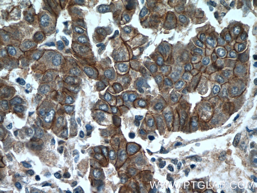 Immunohistochemistry (IHC) staining of human liver cancer tissue using Beta Catenin Polyclonal antibody (51067-2-AP)