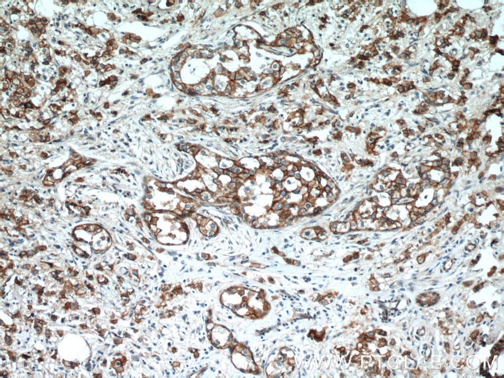 Immunohistochemistry (IHC) staining of human breast cancer tissue using Beta Catenin Polyclonal antibody (51067-2-AP)