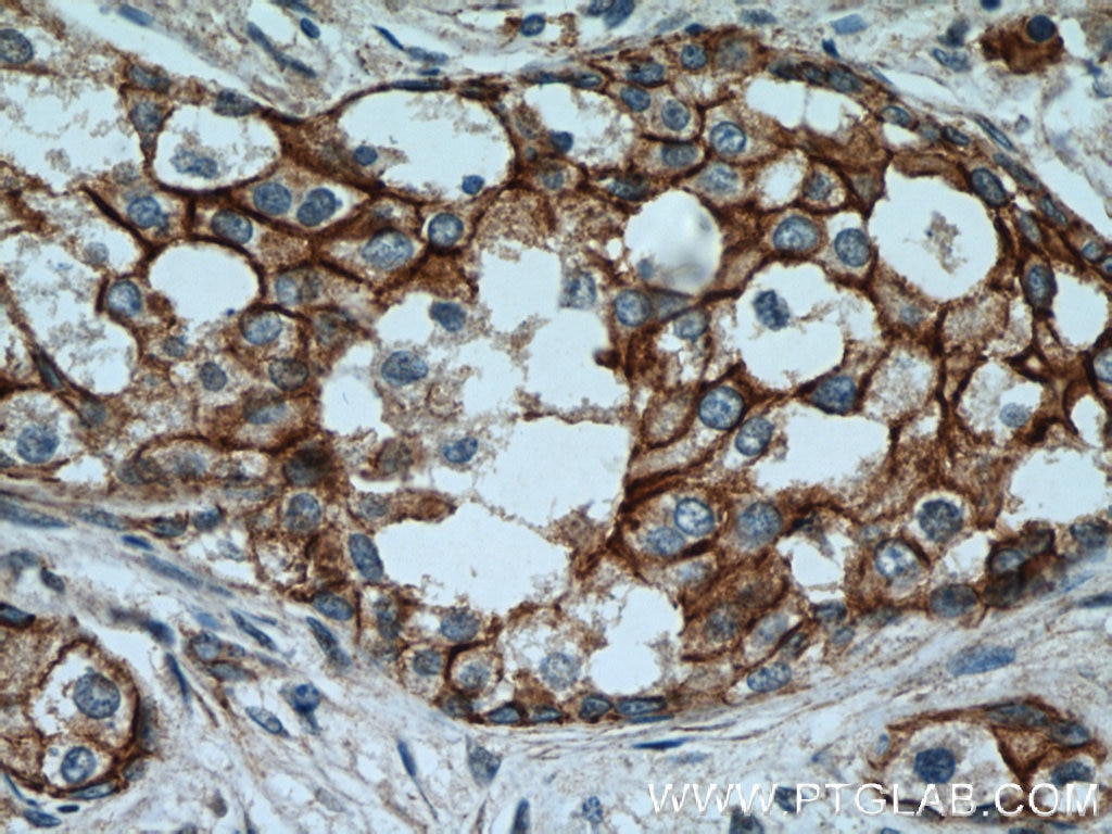 Immunohistochemistry (IHC) staining of human breast cancer tissue using Beta Catenin Polyclonal antibody (51067-2-AP)