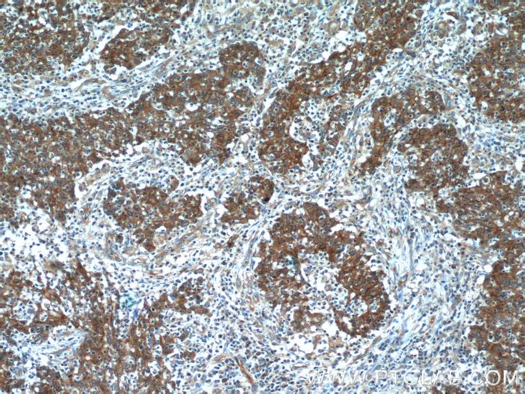 Immunohistochemistry (IHC) staining of human colon cancer tissue using Beta Catenin Polyclonal antibody (51067-2-AP)