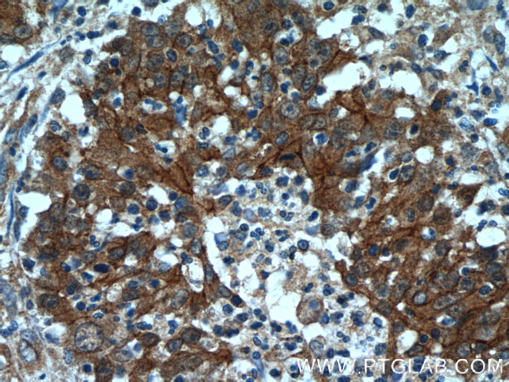 Immunohistochemistry (IHC) staining of human colon cancer tissue using Beta Catenin Polyclonal antibody (51067-2-AP)