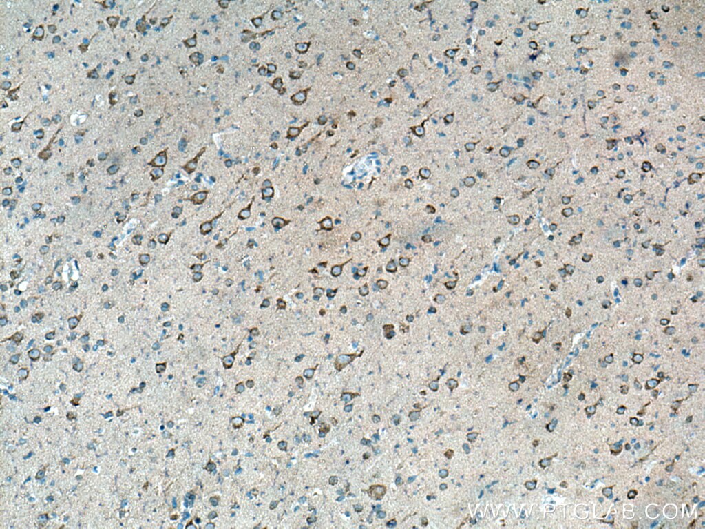 Immunohistochemistry (IHC) staining of human gliomas tissue using APP Polyclonal antibody (27320-1-AP)