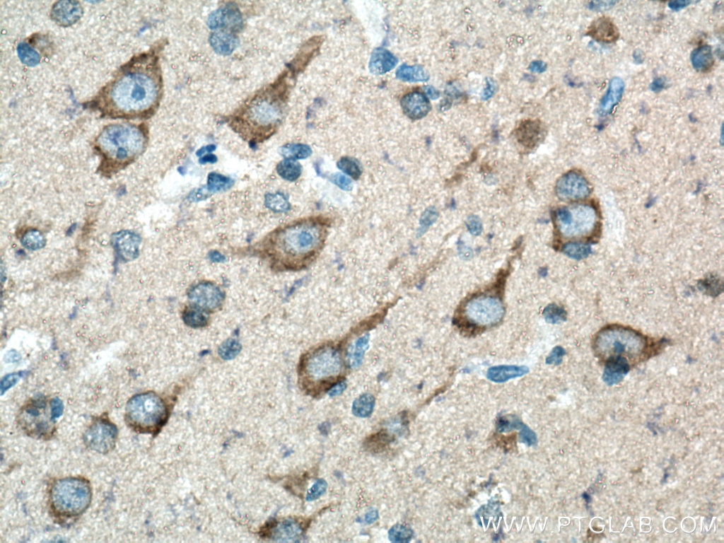 Immunohistochemistry (IHC) staining of human gliomas tissue using APP Polyclonal antibody (27320-1-AP)