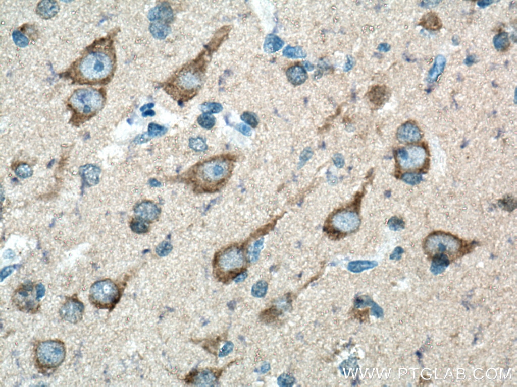 IHC staining of human gliomas using 27320-1-AP