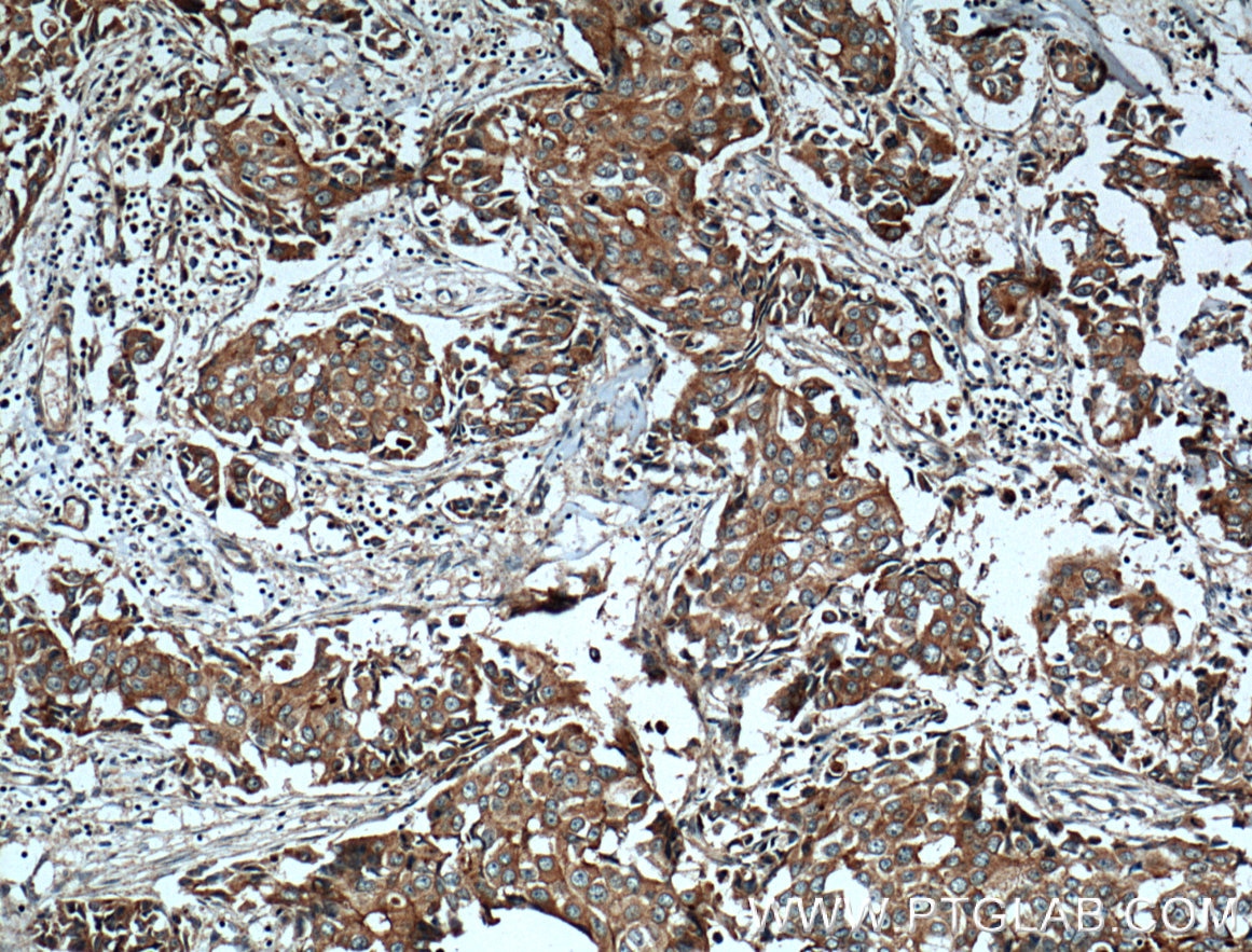 Immunohistochemistry (IHC) staining of human breast cancer tissue using c-SRC Polyclonal antibody (25978-1-AP)