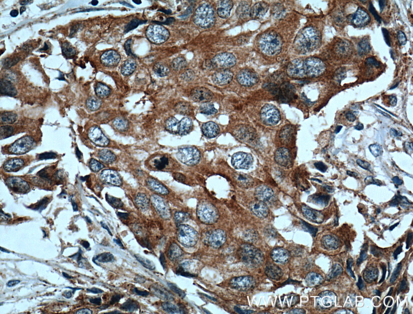 Immunohistochemistry (IHC) staining of human breast cancer tissue using c-SRC Polyclonal antibody (25978-1-AP)