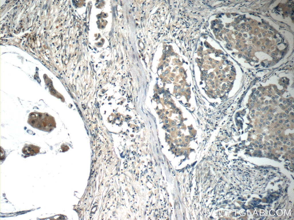 Immunohistochemistry (IHC) staining of human breast cancer tissue using c-SRC Monoclonal antibody (60315-1-Ig)
