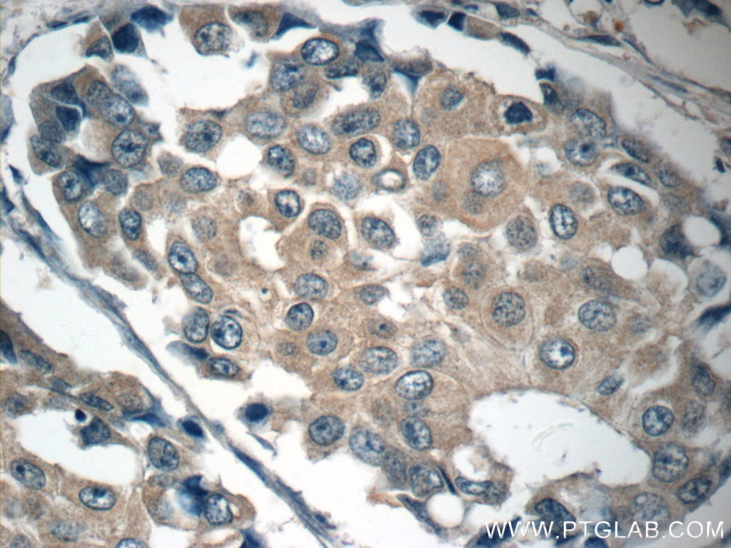 Immunohistochemistry (IHC) staining of human breast cancer tissue using c-SRC Monoclonal antibody (60315-1-Ig)