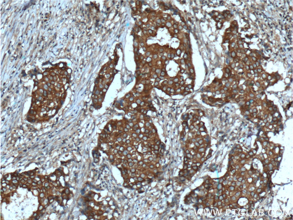 IHC staining of human breast cancer using 60315-1-Ig