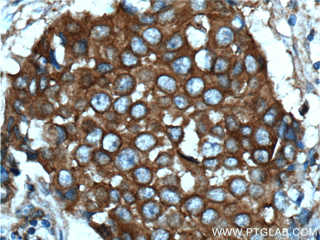 Immunohistochemistry (IHC) staining of human breast cancer tissue using c-SRC Monoclonal antibody (60315-1-Ig)