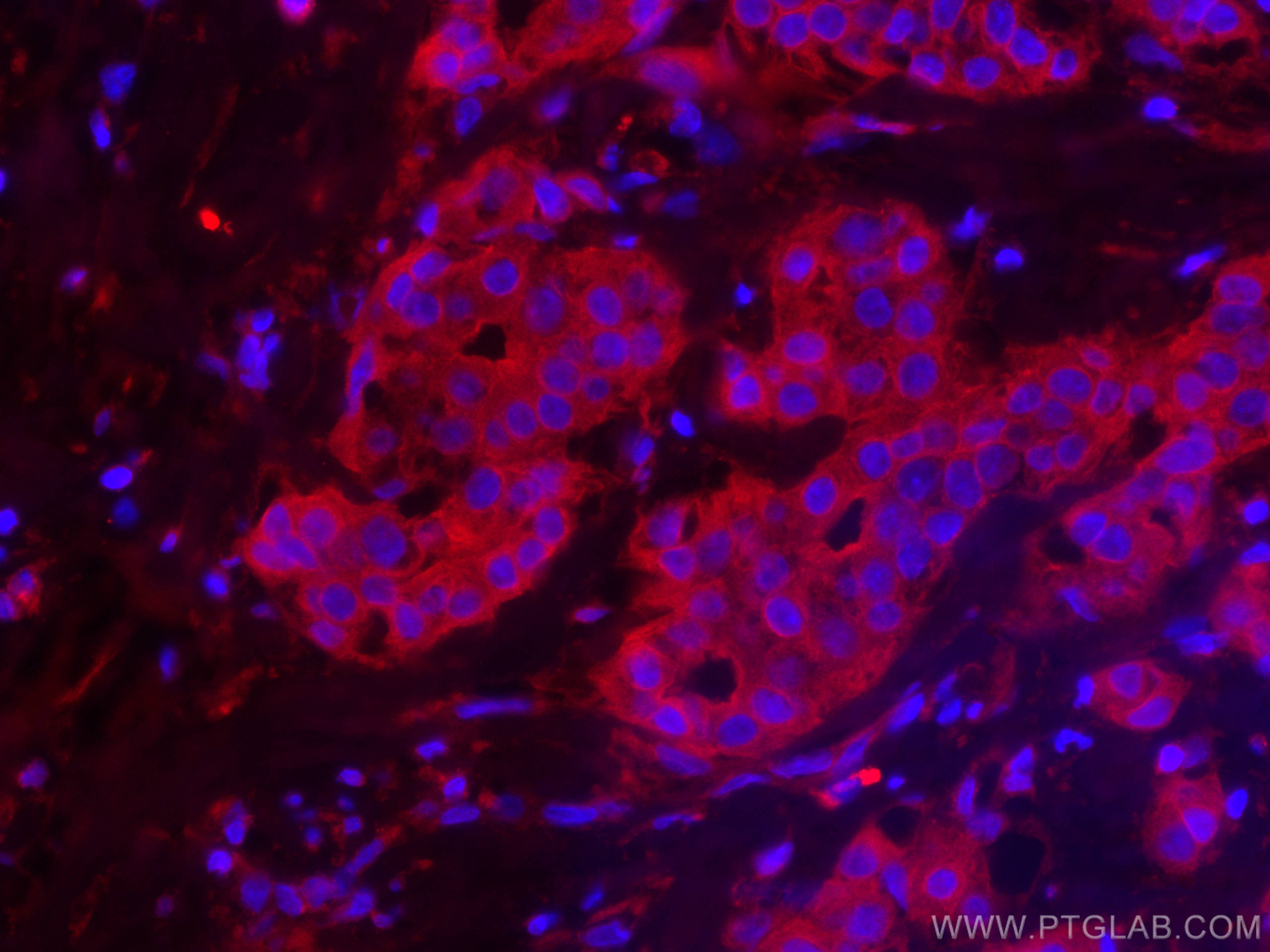 Immunofluorescence (IF) / fluorescent staining of human breast cancer tissue using CoraLite®594-conjugated c-SRC Monoclonal antibody (CL594-60315)