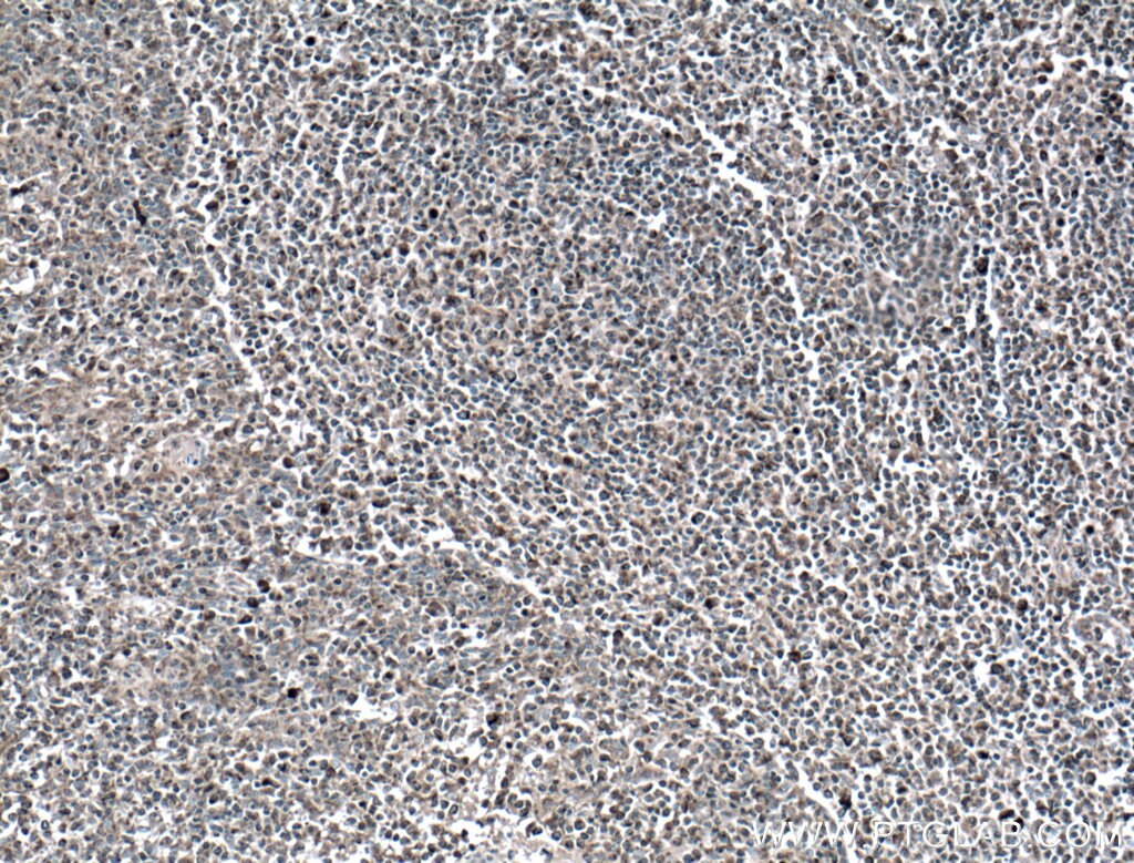 Immunohistochemistry (IHC) staining of human tonsillitis tissue using cIAP1 Monoclonal antibody (66626-1-Ig)