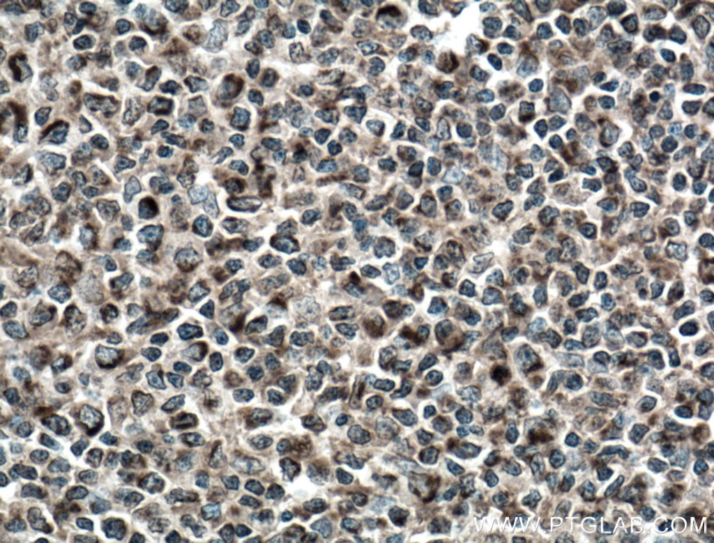 Immunohistochemistry (IHC) staining of human tonsillitis tissue using cIAP1 Monoclonal antibody (66626-1-Ig)