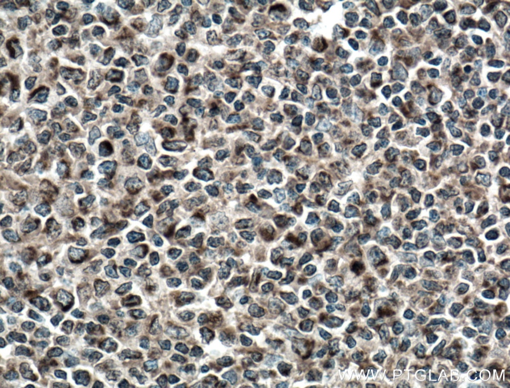 Immunohistochemistry (IHC) staining of human tonsillitis tissue using cIAP1 Monoclonal antibody (66626-1-Ig)