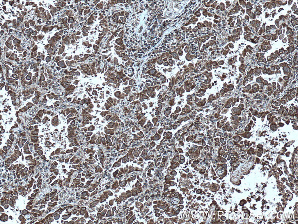 IHC staining of human lung cancer using 66626-1-Ig