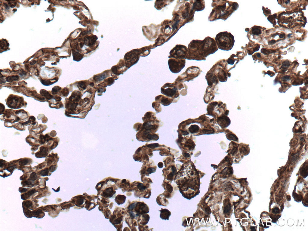 IHC staining of human lung cancer using 66626-1-Ig