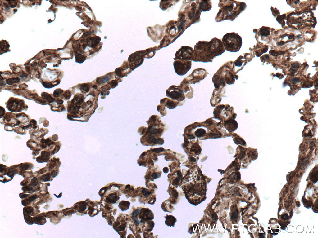 Immunohistochemistry (IHC) staining of human lung cancer tissue using cIAP1 Monoclonal antibody (66626-1-Ig)