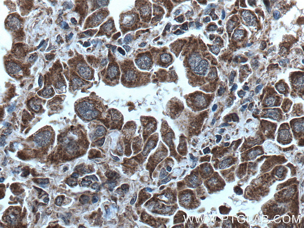 Immunohistochemistry (IHC) staining of human lung cancer tissue using cIAP1 Monoclonal antibody (66626-1-Ig)
