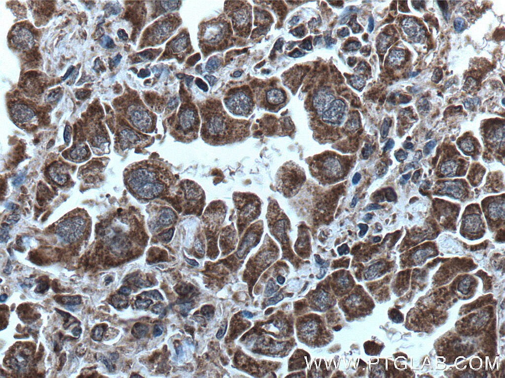 IHC staining of human lung cancer using 66626-1-Ig