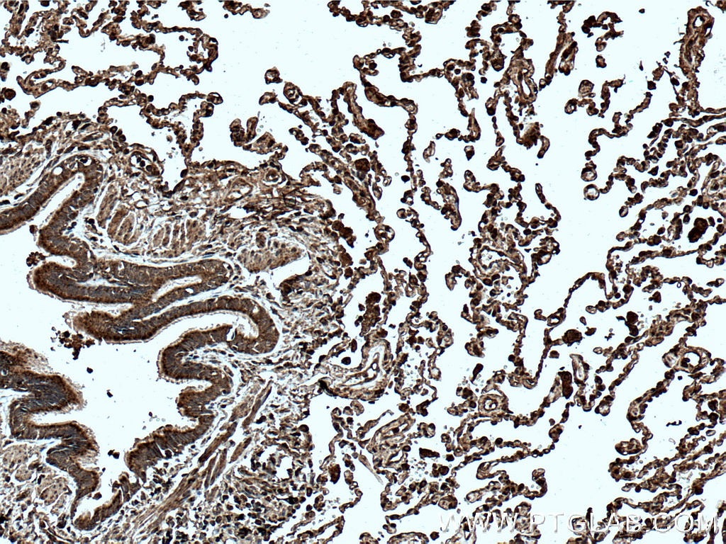 IHC staining of human lung cancer using 66626-1-Ig