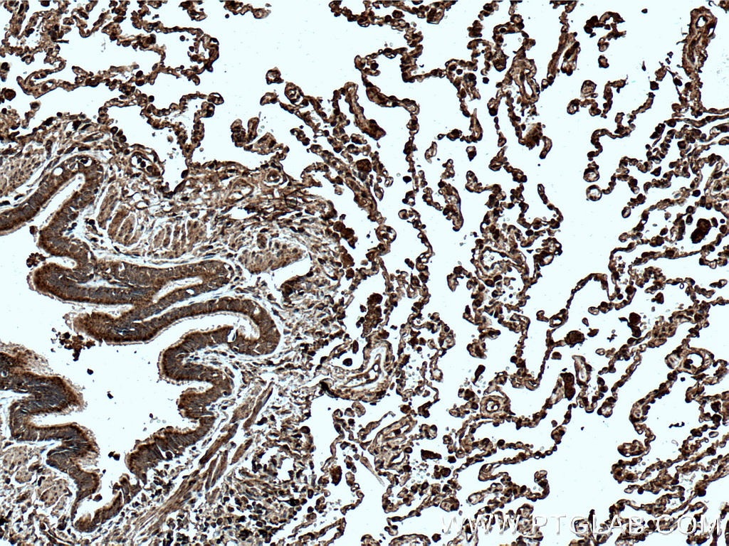 Immunohistochemistry (IHC) staining of human lung cancer tissue using cIAP1 Monoclonal antibody (66626-1-Ig)