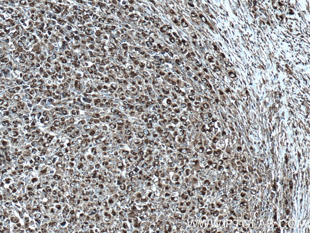 Immunohistochemistry (IHC) staining of human lymphoma tissue using cIAP1 Monoclonal antibody (66626-1-Ig)