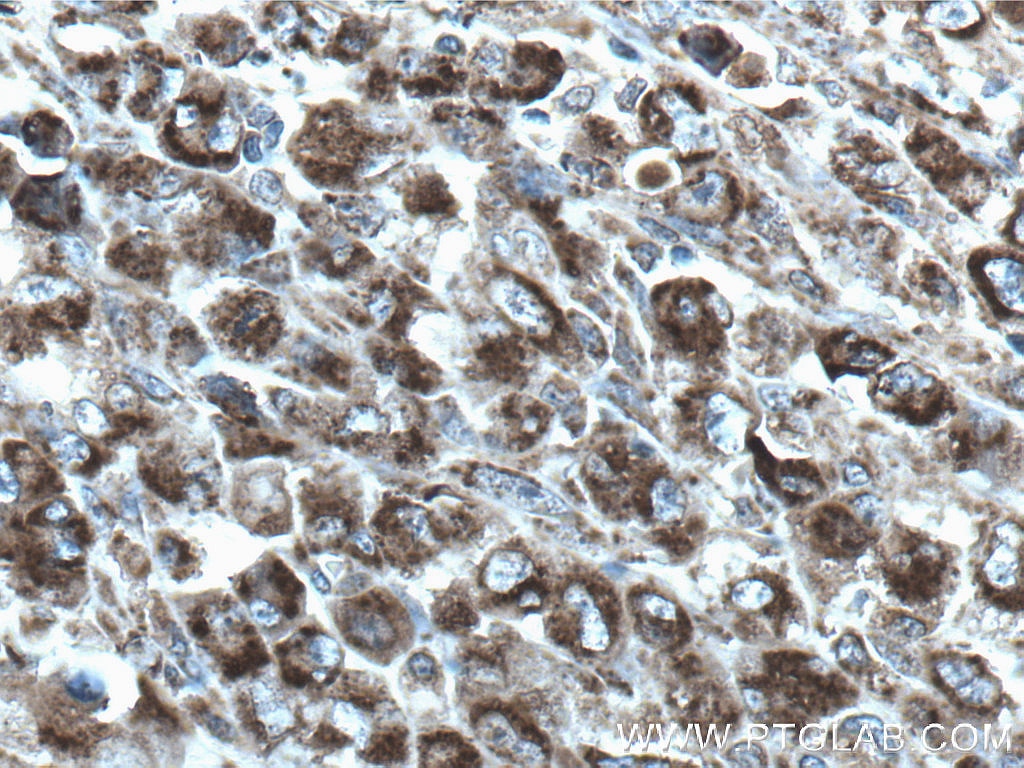 Immunohistochemistry (IHC) staining of human lymphoma tissue using cIAP1 Monoclonal antibody (66626-1-Ig)