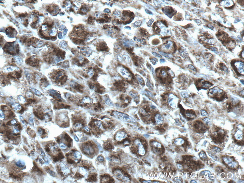 IHC staining of human lymphoma using 66626-1-Ig